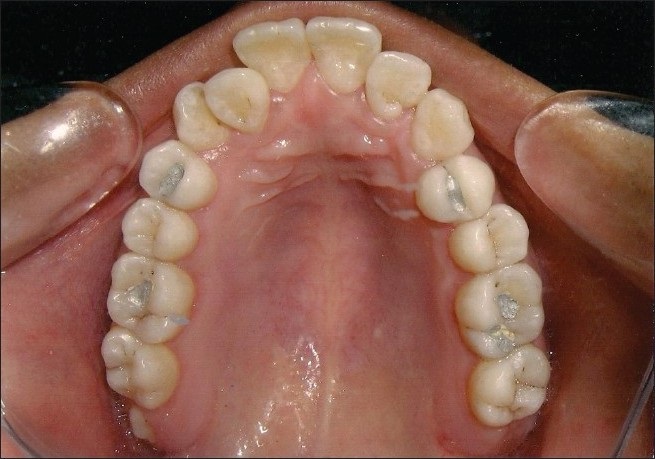 Tooth Crowding
